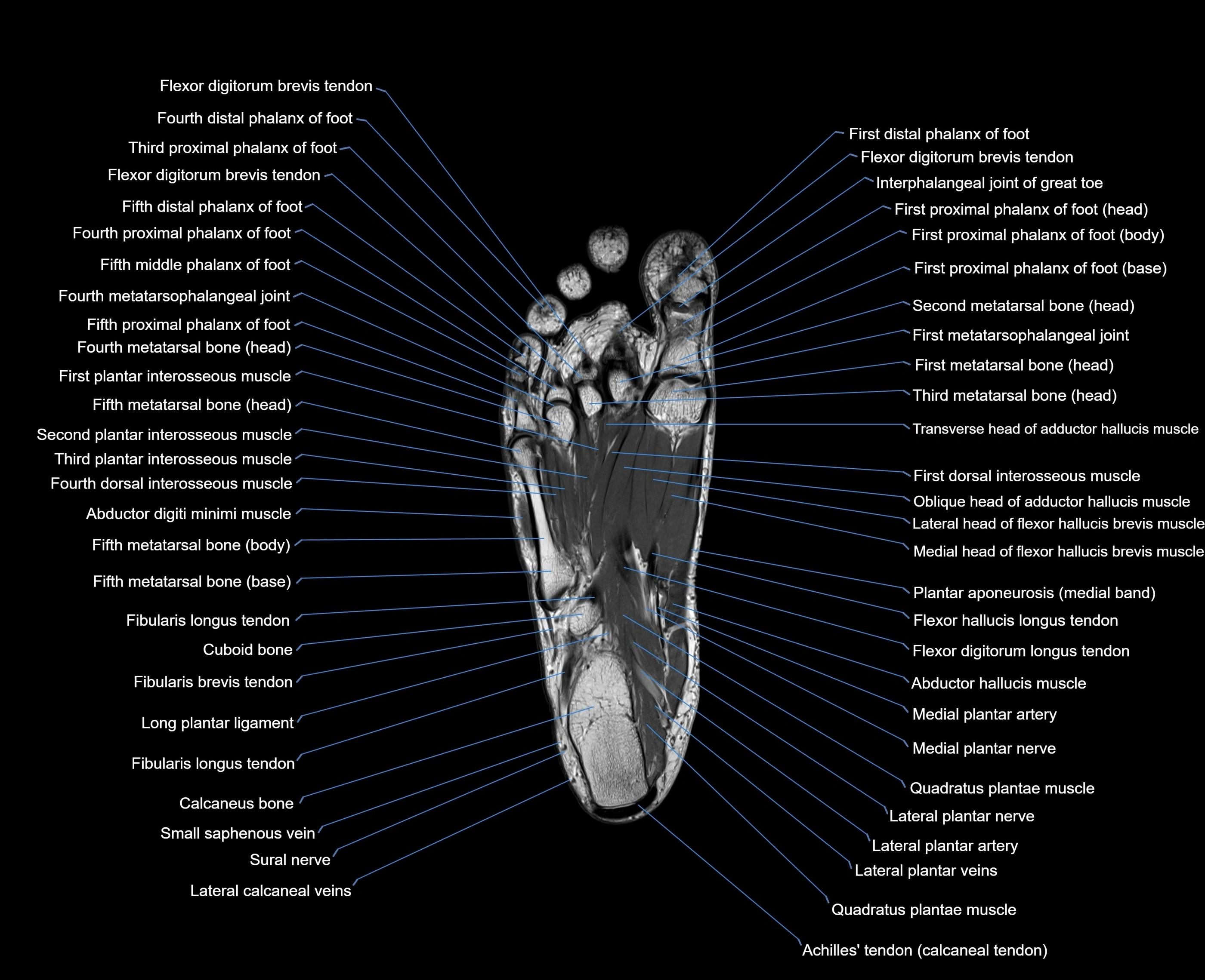 MRI foot coronal cross sectional anatomy 3T  radiology  image-img-00001-00024.webp